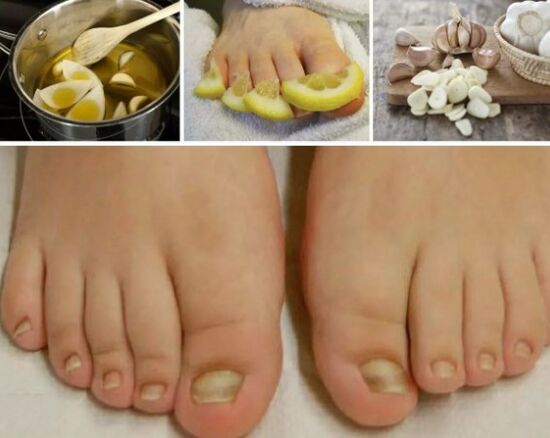 People's recovery for nail fungus
