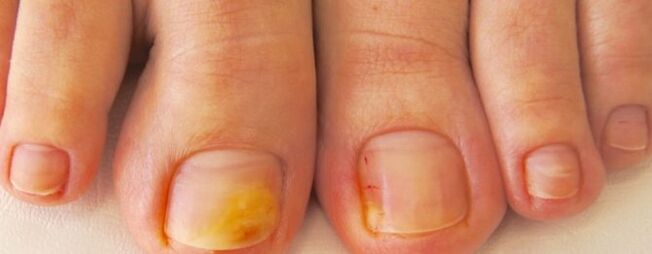Nail fungus
