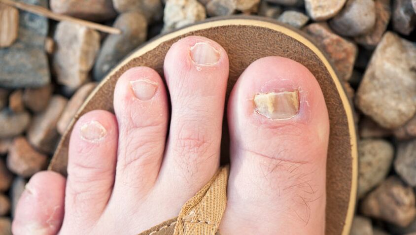 Toenail fungus