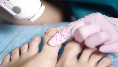 Fungal hardware treatment in the leg