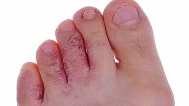 Type and stage of fungal development in the foot