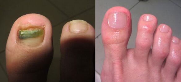 Nail fungal treatment