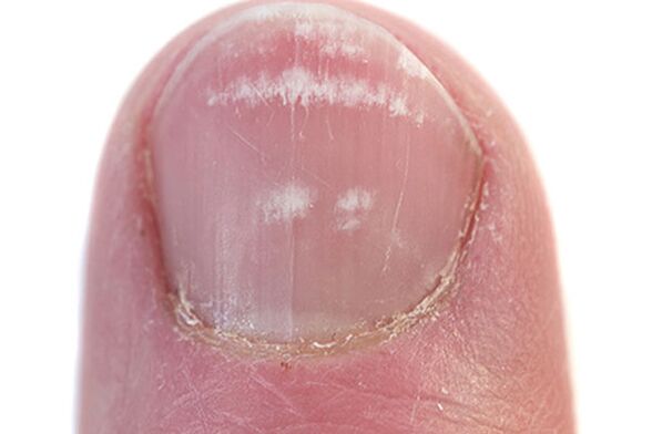 The first sign and symptoms