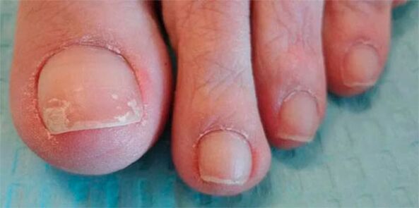 the level of a fungal foot