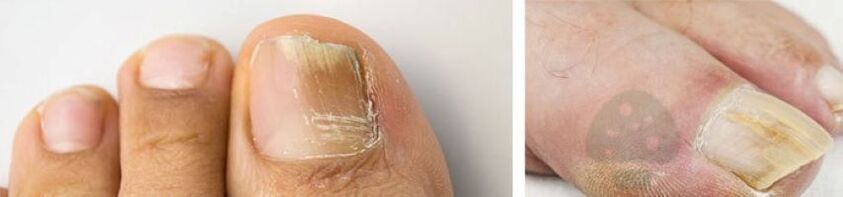 The thumb nail fungus on the feet