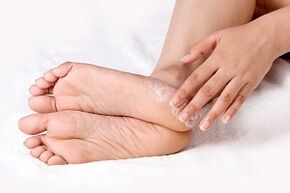Foot fungus treatment with cream