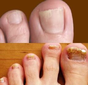 early stages and advanced stages of athlete's foot