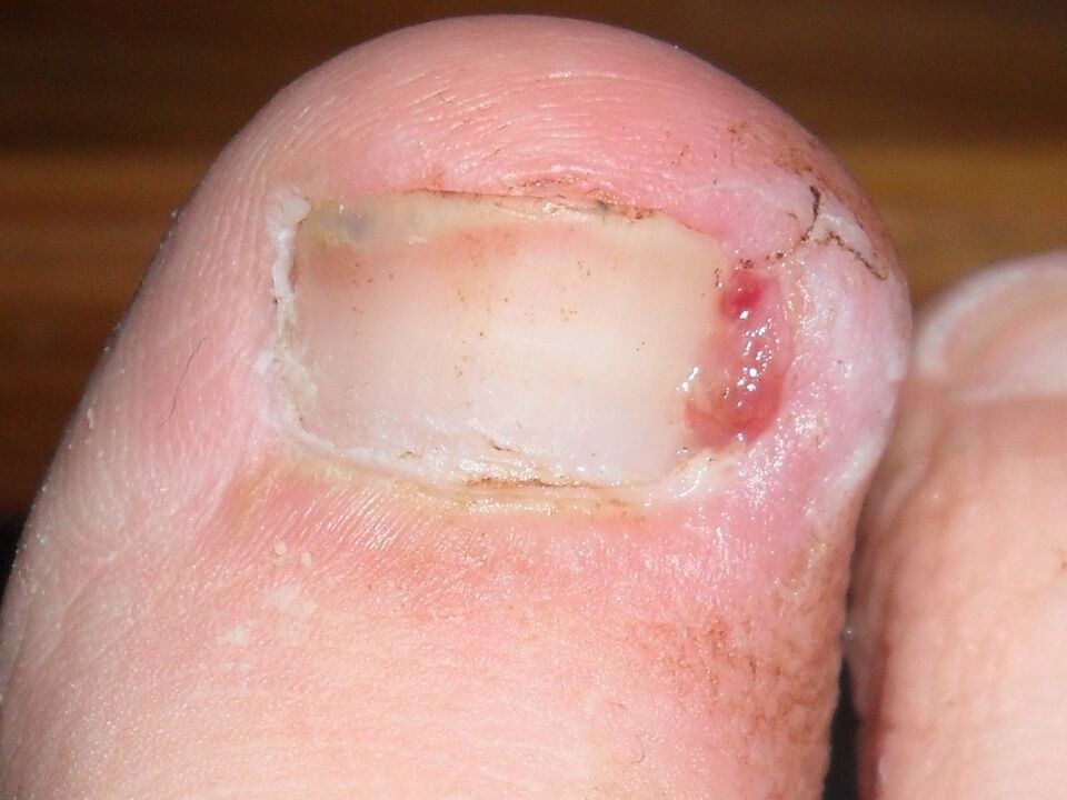 Ingrown toenails are a symptom of a fungal infection