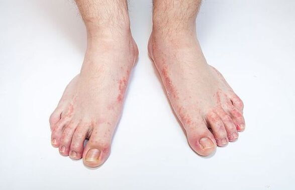 Fungal disease on the skin of the feet