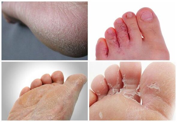 The main manifestation of foot mycosis is skin keratinization, cracking, peeling